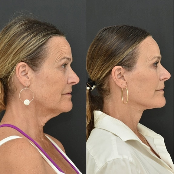 Comparison of two women’s facial features.